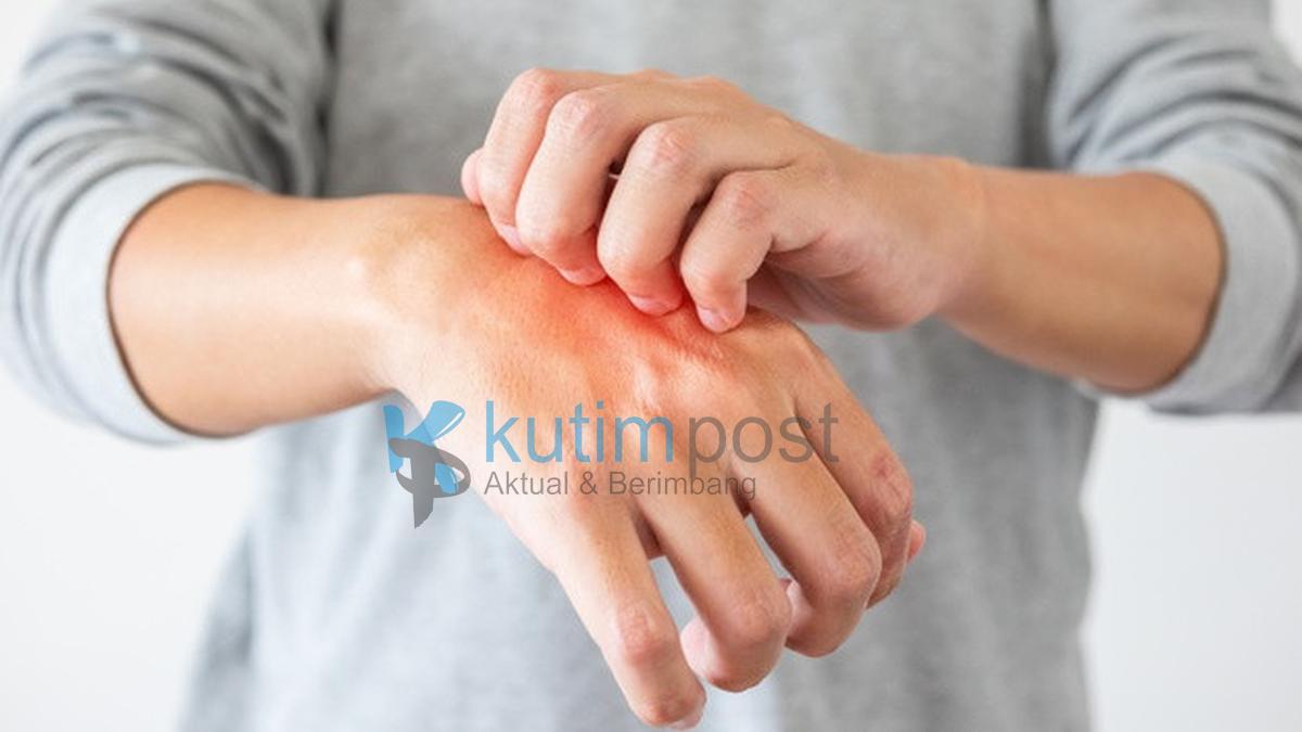 gatal-gatal-dan-ruam-kulit-karena-stres-kok-bisa_1aa78f3.jpg